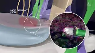 Nucleoplasty - Minimally Invasive Pain Treatment