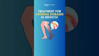 Treatment for #ArterialDiseases in #Mexico! - Medical Tourism