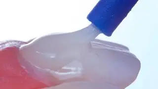 Protocolo Clínico associativo para tratamento de hipersensibilidade dentinária