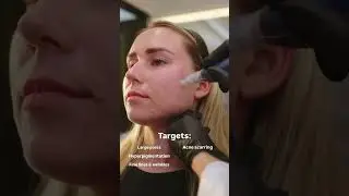 Microneedling in Newport Beach- Skinsation OC