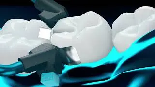 Nuove Sistema di Matrici Sezionali NiTinol by Reinvent