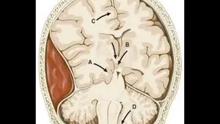 TA-38: Traumatic Brain Injury Recovery &ndash; How TA-65 Supports Neurogenesis and Cognitive Restoration