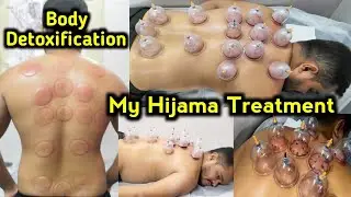 My Back Hijama Treatment l Body Detoxification l Hijama Center Malvani Malad West