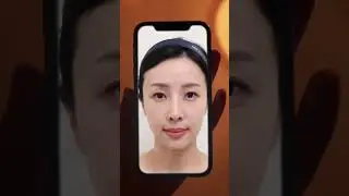 Facial Fat Transfer before & after