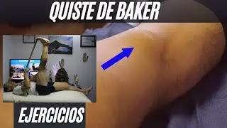 Quiste de Baker/ ¿Qué es?