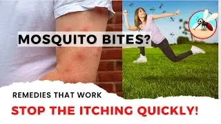 11 Natural Remedies for Mosquito Bites. Stop the Itching Quickly!