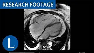Cine cardiovascular MRI of the right ventricle in a patient with heart failure symptoms