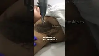 Dark Underarms treatment | Laser treatment | Nagpur #drayeshafaizan #skinclinicnearme  #indianskin