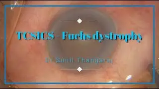 TCSICS in a case of Diabetic cataract with Fuch's endothelial dystrophy