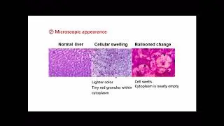 2.2.1 Cell Injury - Cell Swelling and Fatty Change
