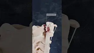 How do anterior and posterior arch C1 fractures affect spinal stability? Explained in 3D