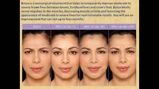 Botox treatment Washington DC