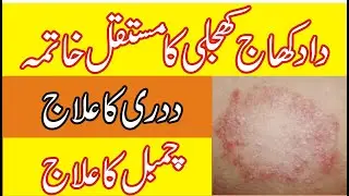 Daad ka ilaj / Daad khaj khujli ka ilaj / Chambal ka ilaj / Ringworm ka ilaj /fungal infections