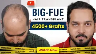 Hair Transplant in Surat | Amazing Hair Transplant Results & Best Hair Transplant Doctor in Surat