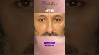 Enhance Your Beauty! Experience Amazing Cheek Fillers At Delooks Clinic!
