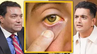 Urine Therapy For Eye Problems - Top Doc Explains
