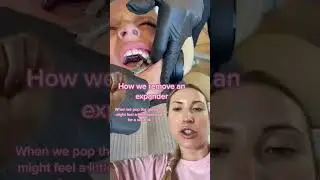 Как снять расширитель #шорты #расширитель #ортодонтия