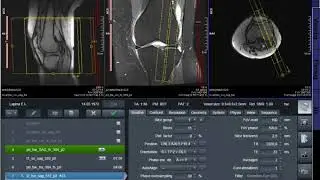 MRI planning Knee