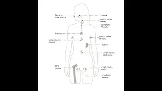 Lymphocyte Depleted Hodgkin's Lymphoma; Definition, Histology Features, Symptoms, Diagnosis, Treat