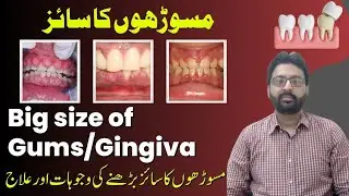Big size of gums/gingiva : Enlargement or Overgrowth