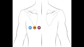 posterior myocardial infarction
