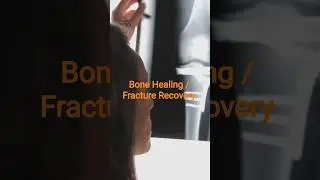 Broken Bone Fast Healing Diet #health #fracture #diet #calcium#vitaminD#weakbones #fracturebone.
