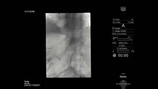 Percutaneous gastrostomy tube placement - 1st draft
