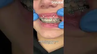 This is the Best Cure for Openbite #braces