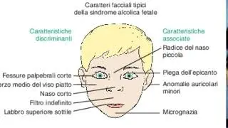 Un caso clinico di sindrome alcolica fetale