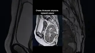 Очень большая опухоль прямой кишки на снимках МРТ в разных проекциях