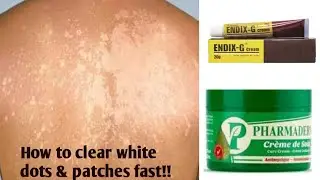 HOW TO CLEAR WHITE PATCHES OR SKIN BLEACHING DOTS IN ONE WEEK!  + BEST PRODUCTS FOR WHITE PATCHES