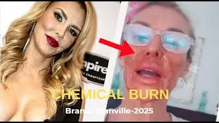 Brandi Glanville Gets CHEMICAL BURN on Face After Trying to Remove a Parasite