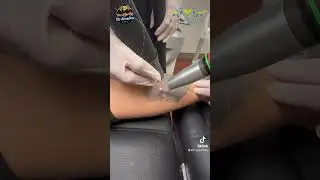 Full Length Laser 💥 Tattoo ⚡️ Removal Calf Tattoos, 3rd treatment Video at Las Vegas Dermatology