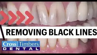 Case of the Week - Removing black lines