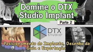 Passo a passo no DTX Studio Implant: Smart setup, posição do implante, confecção e download do guia