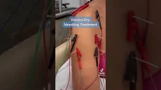 Dry needling with electrical stimulation. #PhysicalTherapy treatment. #PT #dryneedling #injury #mke