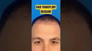 Surgeon Revises Botched Hair Transplant!