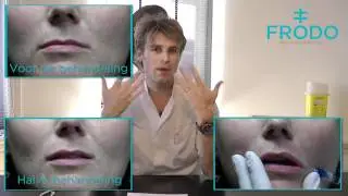 Lippen vergroten met hyaluronzuur | lippen opvullen