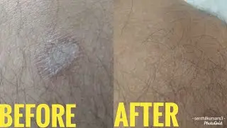 Best fungal skin  infection cream | ring guard cream | ringworm treatment before and after results