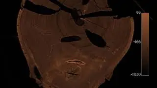 Log CT Scan: ALB tree damage.