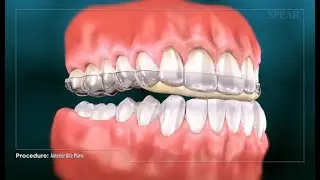 Occlusale spalk voor gebitsslijtage   Orthodontie Antwerpen MyDent