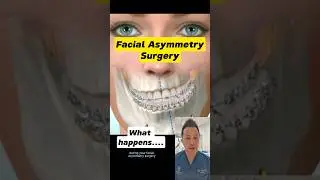 Facial Asymmetry Surgery: What to Expect #dentallan #shorts #dentist
