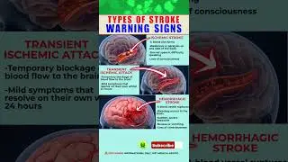 3 Common Types of Stroke You Should Know