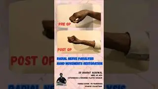 Tendon Transfer surgery, Radial Nerve Palsy, Dr Bharat Agarwal, Udaipur Plastic Surgeon