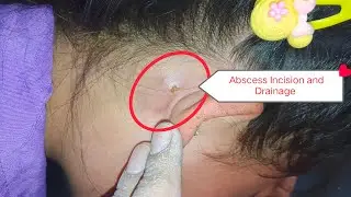 Post-Auricular Abscess | Incision and Drainage Procedure