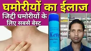 मात्र 2 दिन में  घमोरियों का ईलाज II Keto Dusting Powder Uses In Hindi II
