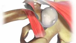 Depuy 2 incision 3d medical animation