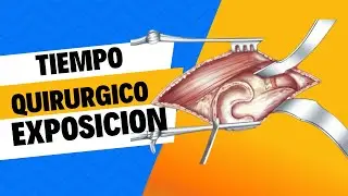 tiempo quirúrgico exposición (separación, aspiración y tracción)
