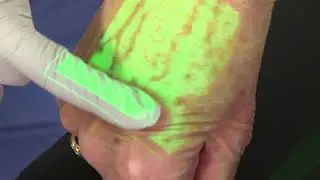 AccuVein AV500 Vein Wipe