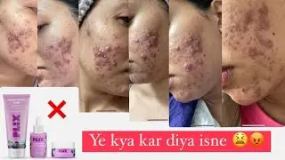 Honest review part 2🤞🏻|| Plix jamun serum, moisturiser, face wash || @Ritika.M.T